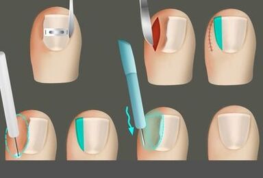 Премахване на нокътя в присъствието на гъбичка на краката