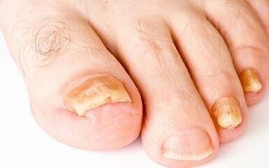 Фото симптоми на гъбички за нокти