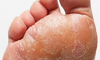 Признаци и симптоми на гъбички по краката